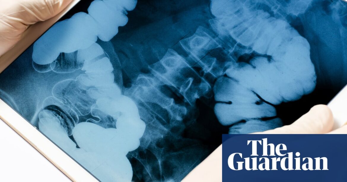 The ick factor that could save a life: US cancer researchers look to fecal waste for treatment clues | US news