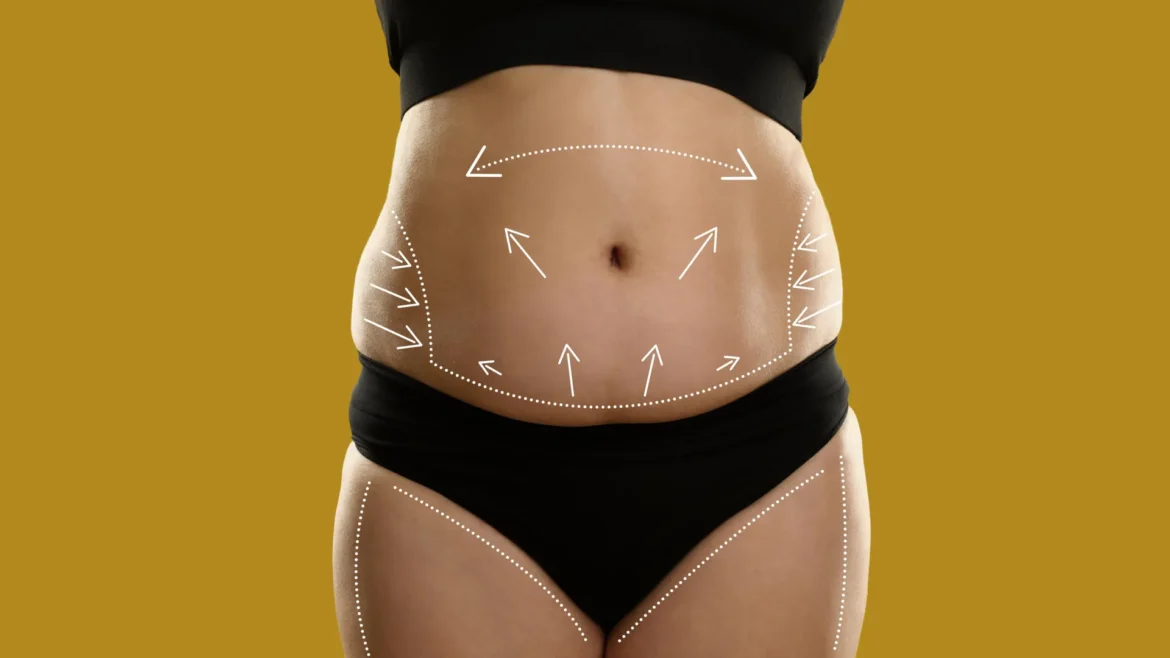 Study finds tummy-tuck patients still shedding pounds five years later